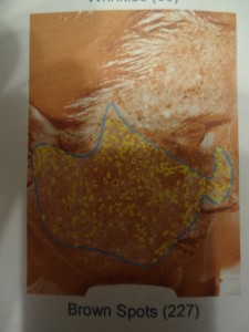 Brown spots - UV damage