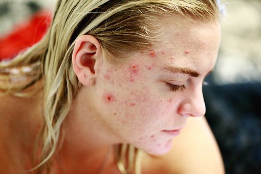 Blonde haired female in her late twenties. close up of the side of her face with bad adult acne.