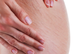 close up of the stretchmarls on a woman's stomach