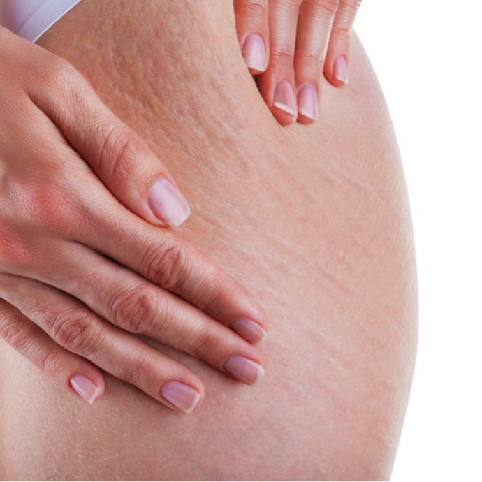 close up of the stretchmarls on a woman's stomach