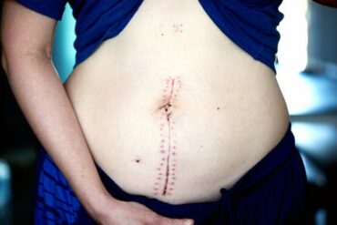 close up of a woman's stomach with a scar downt he centre of it indicating her path to a speedy recovery post-surgery