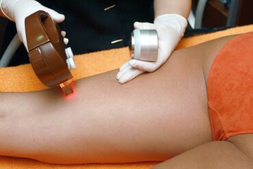 close up of the back of a woman's legs as she receives laser hair removal treatment